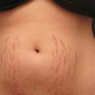 Stretch Marks Removal – Simply Better Skin