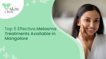 Melasma Treatments in Mangalore