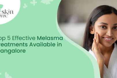 Melasma Treatments in Mangalore