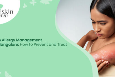 Skin Allergy Management in Mangalore