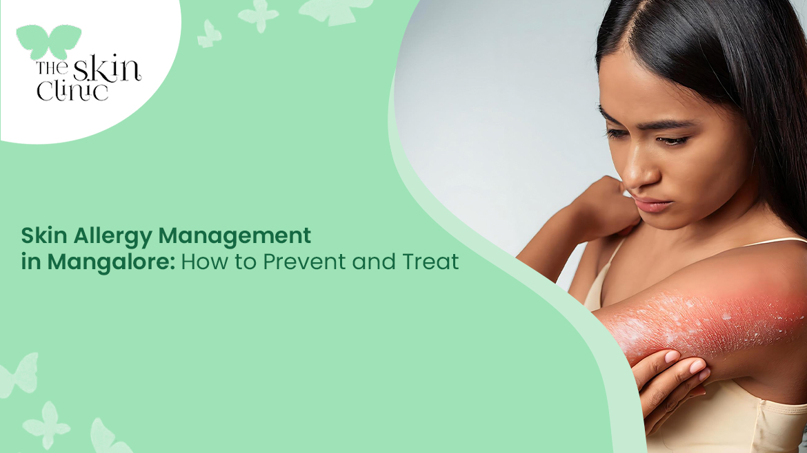 Skin Allergy Management in Mangalore