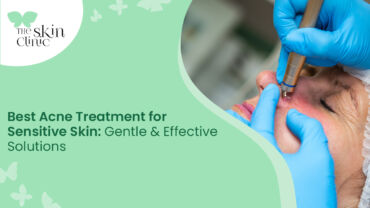 Acne Treatment in Mangalore